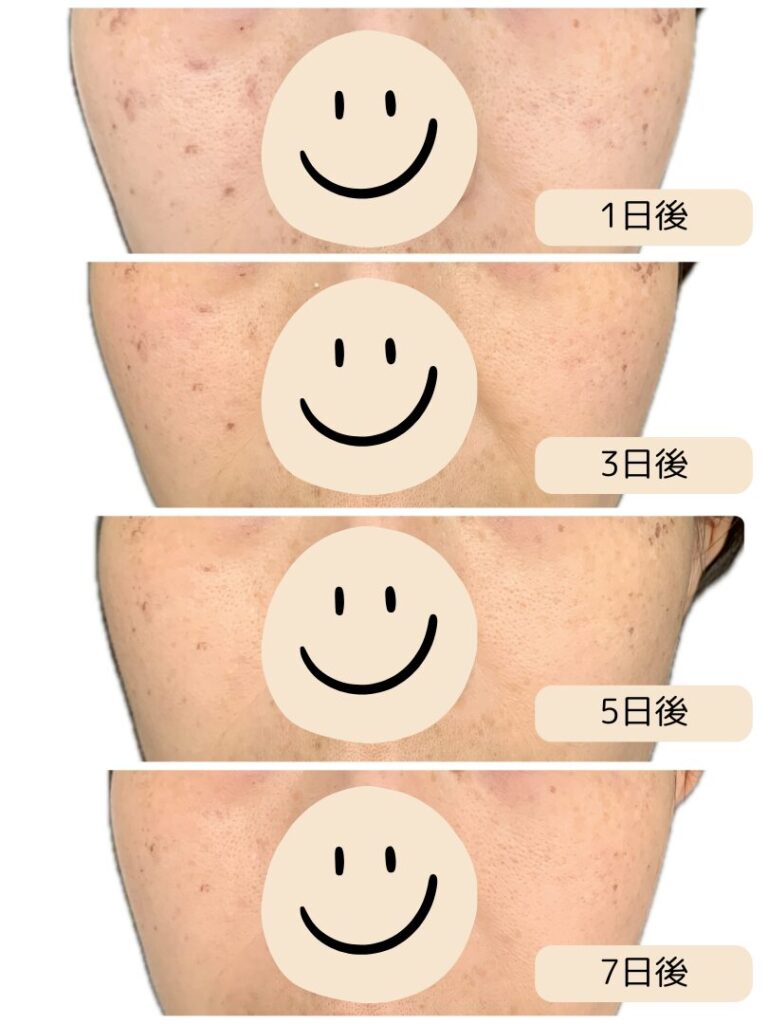 シミ取り後の経過