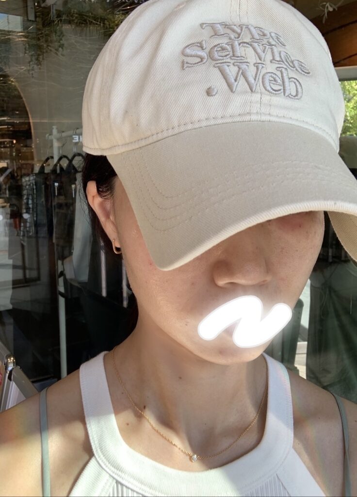 ピコレーザー直後の実際の写真